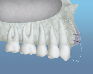 Bone Grafting,