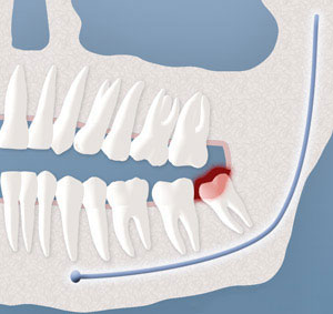 Wisdom Teeth Removal,