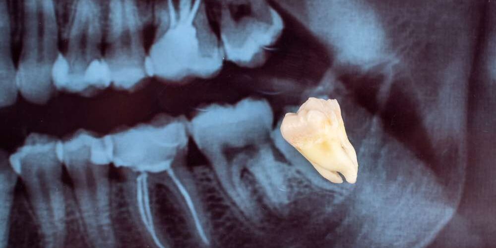 Can I Go to Work the Next Day After Wisdom Tooth Extraction Can I Go to Work the Next Day After Wisdom Tooth Extraction?