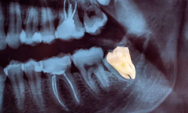 Can I Go to Work the Next Day After Wisdom Tooth Extraction?