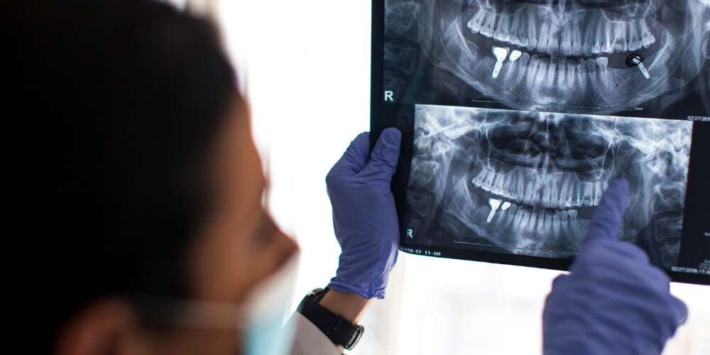 Does bone grow back after an Apicoectomy Does bone grow back after an Apicoectomy?