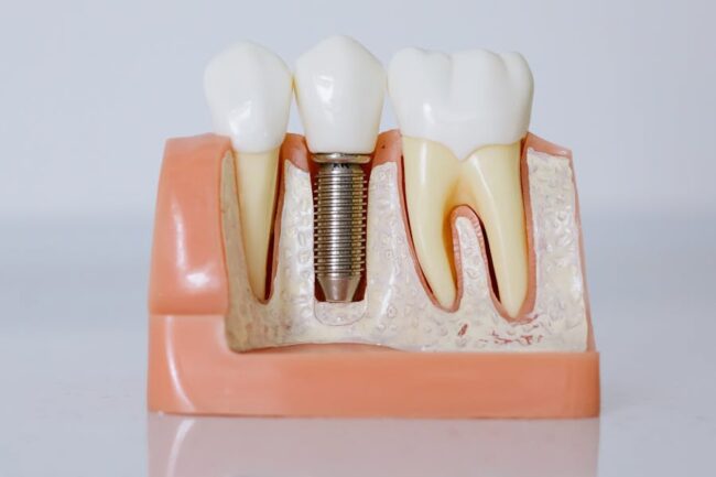Dental Implants vs. Traditional Dentures Which Is Right for You