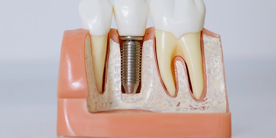 Dental Implants vs. Traditional Dentures Which Is Right for You
