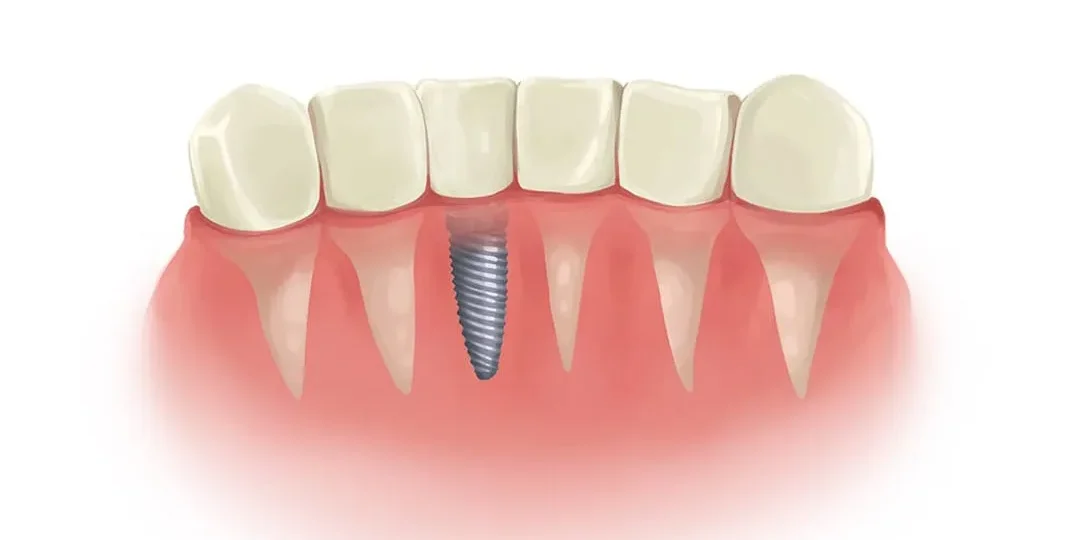 Dental Implants benefits