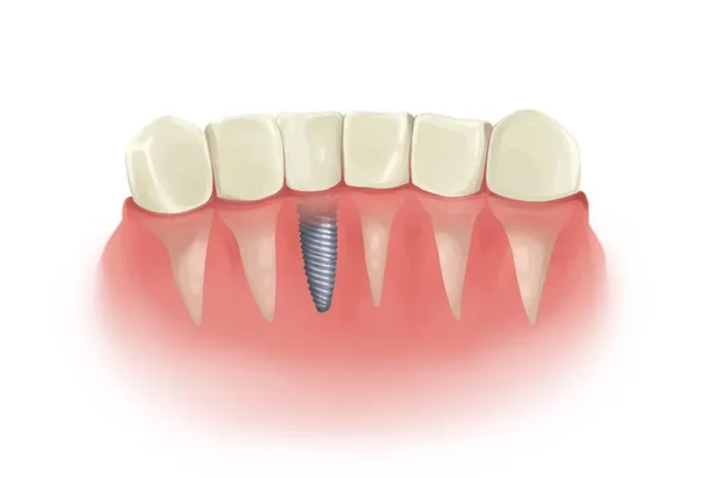 Dental Implants benefits